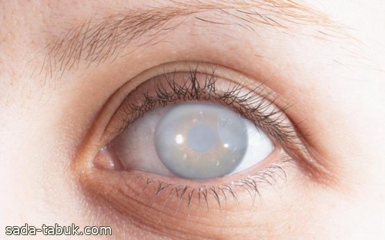 "سعود الطبية" توضح أبرز أعراض إصابة العيون بالماء الأبيض.. وطرق علاجه