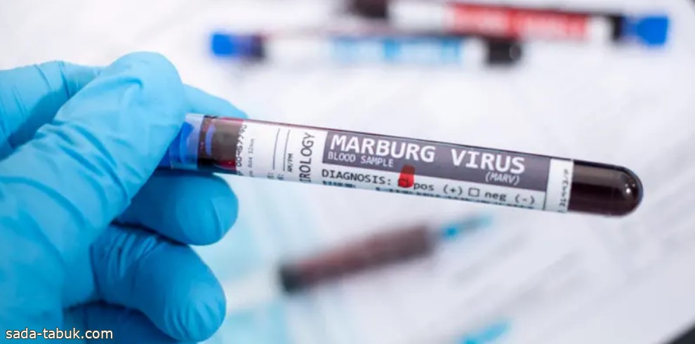 صداع وحمى شديدة.. ماذا نعرف عن فيروس ماربورغ؟
