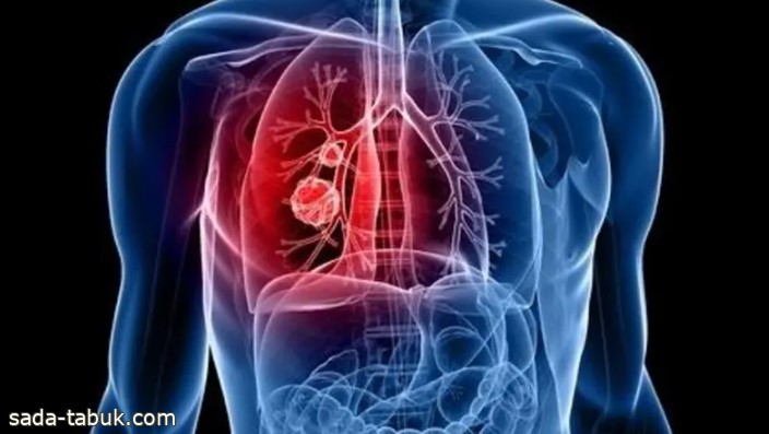 "قاتل خفي" يسبب سرطانات الرئة لغير المدخنين.. دراسة تكشف