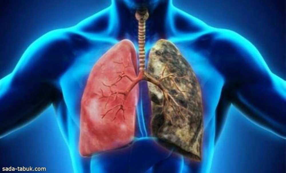 سانوفي: عقارنا لعلاج «رئة المدخن» ناجع