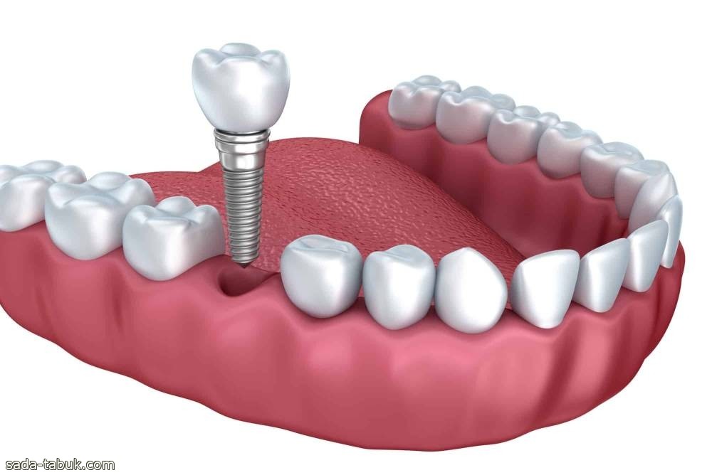 مبتعث يفوز بأفضل علاج متكامل لحالة معقدة في «استعاضة وزراعة الأسنان»