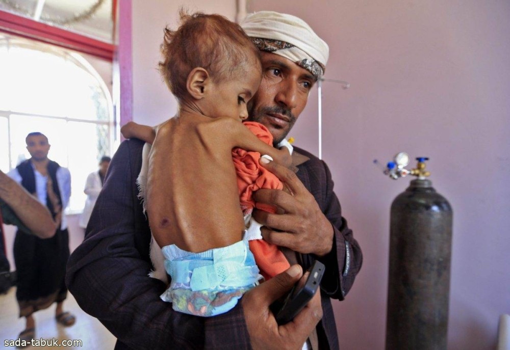 «الغذاء العالمي» يعلق تدخلاته في سوء التغذية باليمن