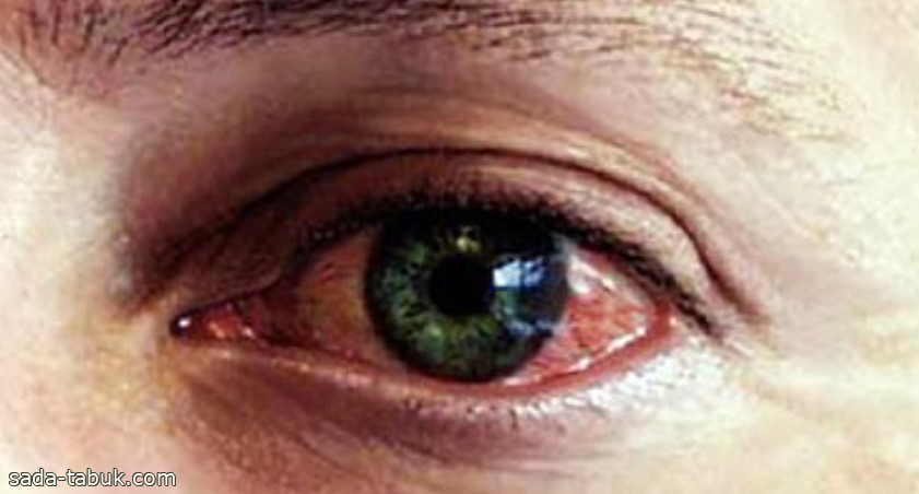 6 أسباب تؤدي إلى نزيف العين