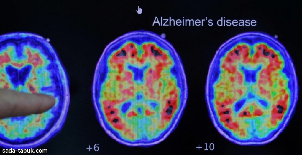 علماء يكتشفون كيف تموت خلايا الدماغ لدى مرضى ألزهايمر