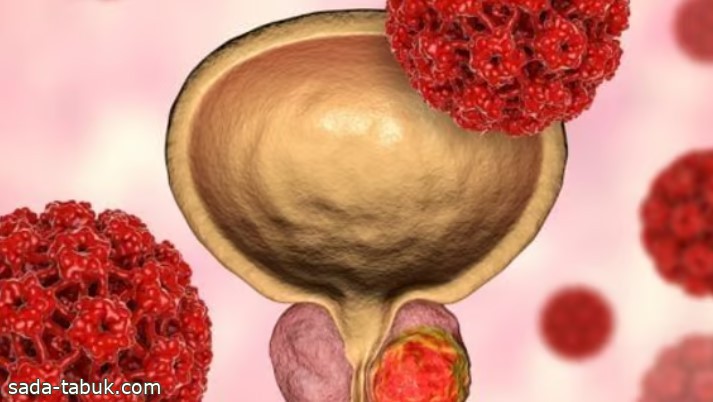 كي لا يطرق "سرطان البروستاتا" بابك..عوامل حاسمة تجنبك حدوثه
