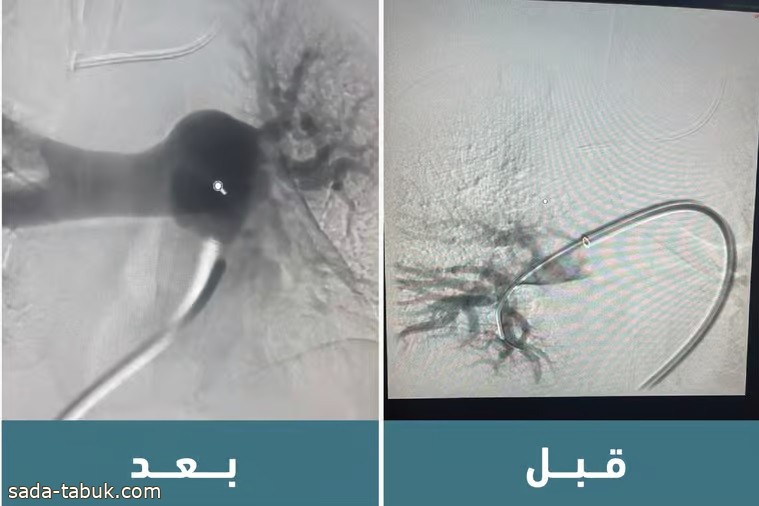 سعود الطبية تنقذ أربعينية أصابتها جلطة رئوية حادة