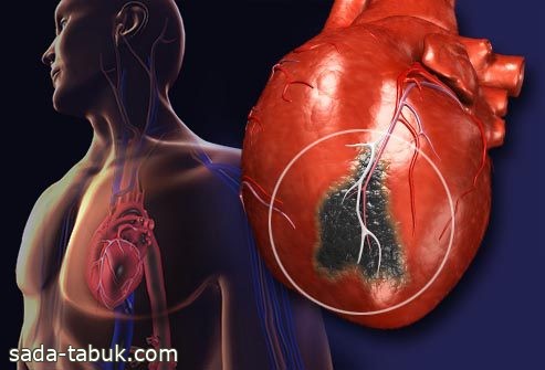 استشاري: التهاب عضلة القلب يشبه الجلطة في الأعراض