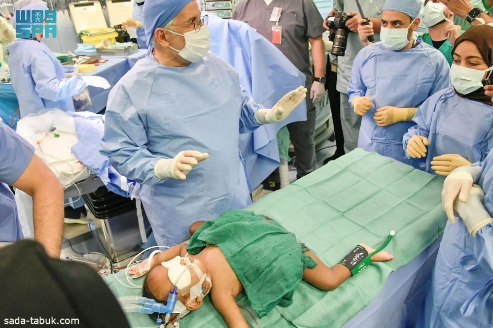نجاح فصل التوأم السيامي النيجيري " حسنة وحسينة " بعد عملية جراحية معقدة استغرقت 16 ساعة ونصف