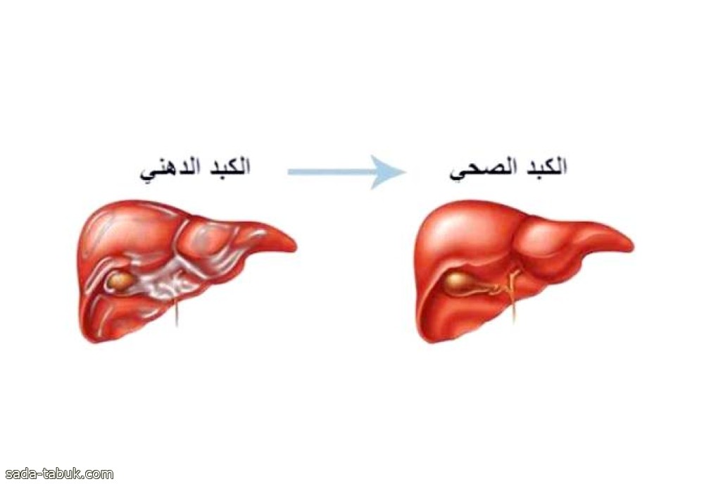 أمريكا توافق على أول دواء لعلاج «الكبد الدهني»